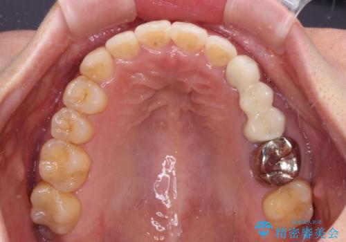 捻れた前歯と銀歯のブリッジを治したい ワイヤー矯正とオールセラミックブリッジの治療後