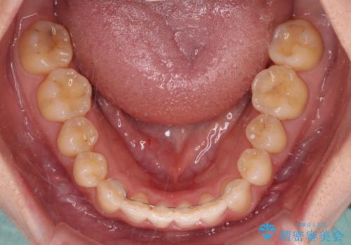 捻れた前歯と銀歯のブリッジを治したい ワイヤー矯正とオールセラミックブリッジの治療後
