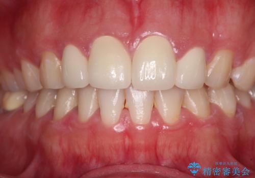 結婚式までに前歯をきれいに　オールセラミッククラウンの審美歯科治療の治療後