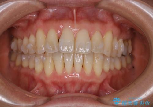 歯ぐき、骨が薄い方のマウスピース矯正治療　非抜歯でもIPR(歯を削る処置)で口元に変化をの治療中