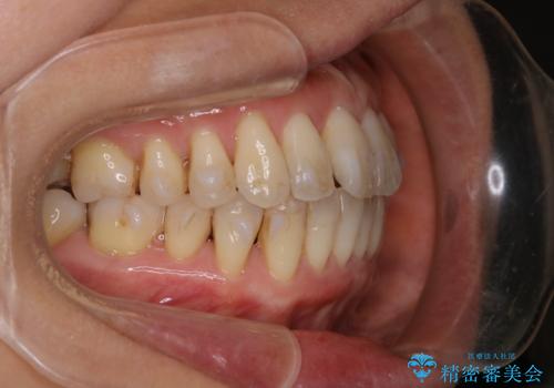 歯ぐき、骨が薄い方のマウスピース矯正治療 非抜歯でもIPR(歯を削る処置)で口元に変化をの治療中