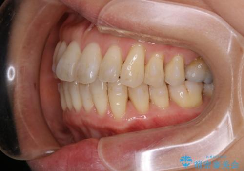 歯ぐき、骨が薄い方のマウスピース矯正治療 非抜歯でもIPR(歯を削る処置)で口元に変化をの治療中