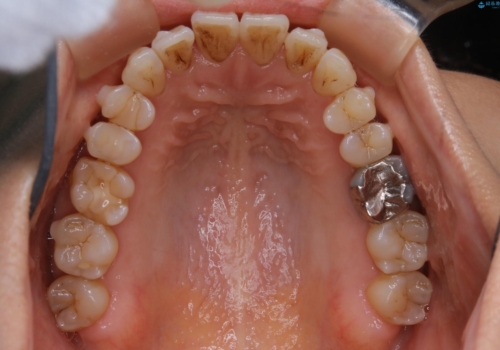 歯ぐき、骨が薄い方のマウスピース矯正治療 非抜歯でもIPR(歯を削る処置)で口元に変化をの治療中