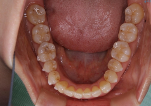 歯ぐき、骨が薄い方のマウスピース矯正治療　非抜歯でもIPR(歯を削る処置)で口元に変化をの治療中