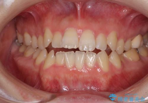 オープンバイトと前歯のデコボコをインビザライン矯正で解消の症例 治療前