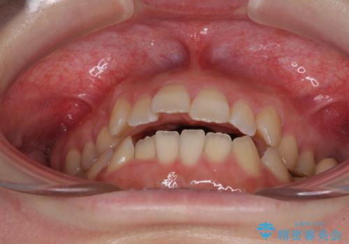 オープンバイトと前歯のデコボコをインビザライン矯正で解消の治療前