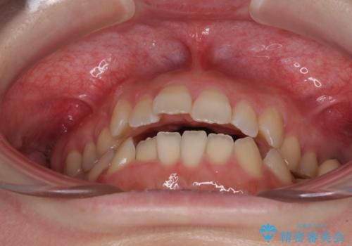 オープンバイトと前歯のデコボコをインビザライン矯正で解消の治療前