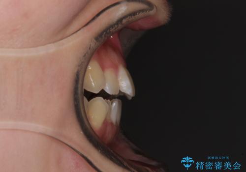 オープンバイトと前歯のデコボコをインビザライン矯正で解消の治療前