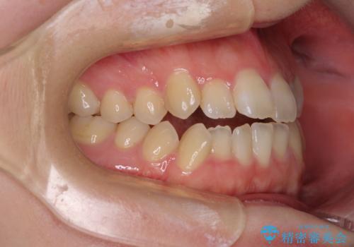 オープンバイトと前歯のデコボコをインビザライン矯正で解消の治療前