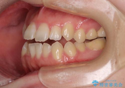 オープンバイトと前歯のデコボコをインビザライン矯正で解消の治療前