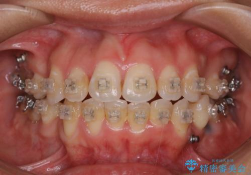 ワイヤー矯正中のクリーニングの治療前
