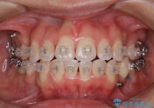 ワイヤー矯正中のクリーニングの治療後