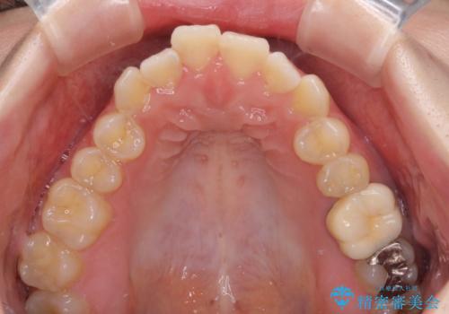 オープンバイトと前歯のデコボコをインビザライン矯正で解消の治療前