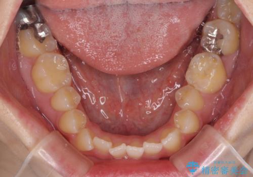 オープンバイトと前歯のデコボコをインビザライン矯正で解消の治療前