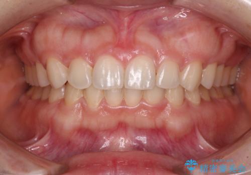 【モニター】前歯の歯列不正をワイヤー装置で短期間矯正治療の症例 治療後