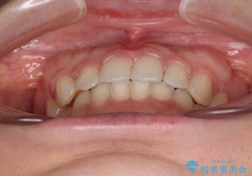 【モニター】前歯の歯列不正をワイヤー装置で短期間矯正治療の治療後