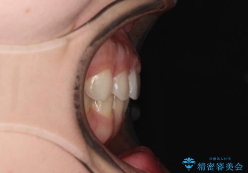 【モニター】前歯の歯列不正をワイヤー装置で短期間矯正治療の治療後