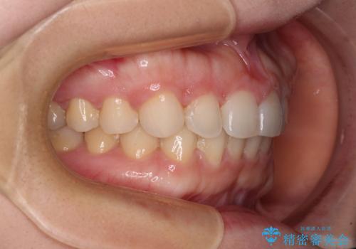 【モニター】前歯の歯列不正をワイヤー装置で短期間矯正治療の治療後