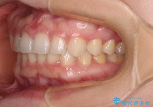 【モニター】前歯の歯列不正をワイヤー装置で短期間矯正治療の治療後