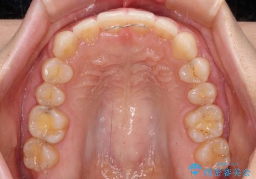 【モニター】前歯の歯列不正をワイヤー装置で短期間矯正治療の治療後