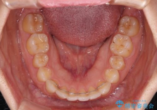 【モニター】前歯の歯列不正をワイヤー装置で短期間矯正治療の治療後