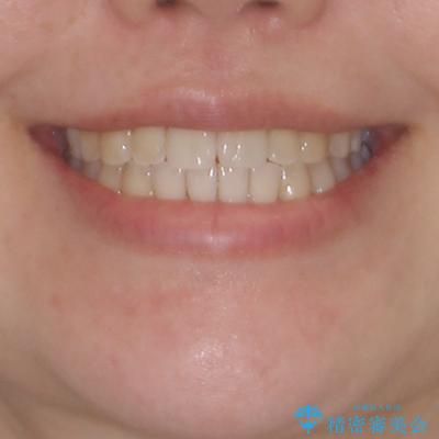 すきっ歯とオープンバイトをインビザラインで改善の治療後（顔貌）