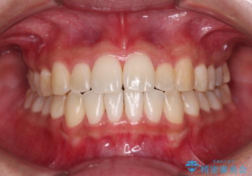 すきっ歯とオープンバイトをインビザラインで改善の症例 治療後