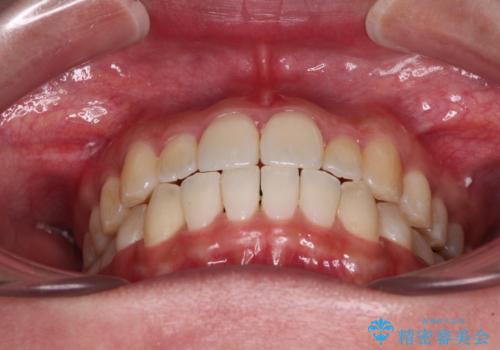すきっ歯とオープンバイトをインビザラインで改善の治療後