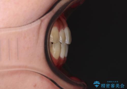 すきっ歯とオープンバイトをインビザラインで改善の治療後