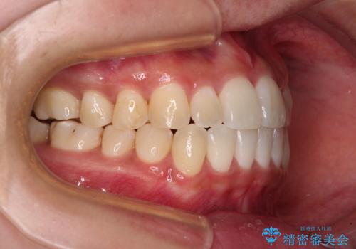 すきっ歯とオープンバイトをインビザラインで改善の治療後