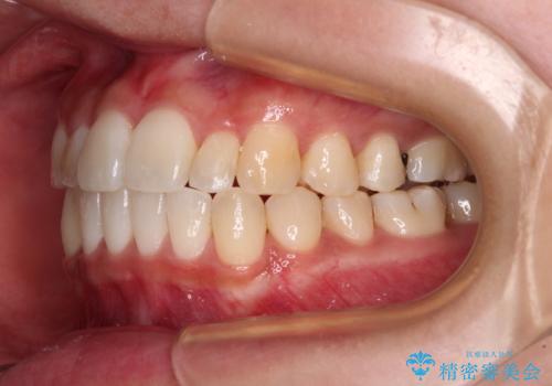 すきっ歯とオープンバイトをインビザラインで改善の治療後