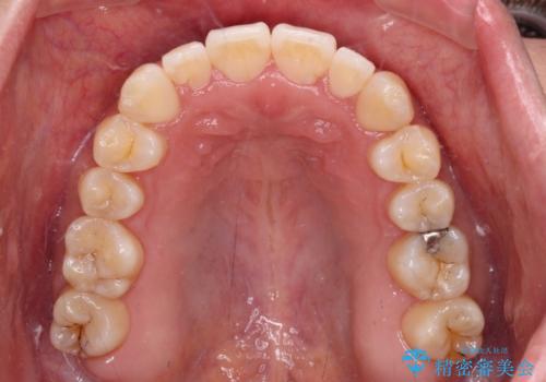 すきっ歯とオープンバイトをインビザラインで改善の治療後