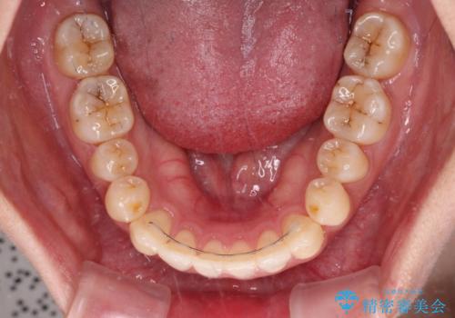 すきっ歯とオープンバイトをインビザラインで改善の治療後