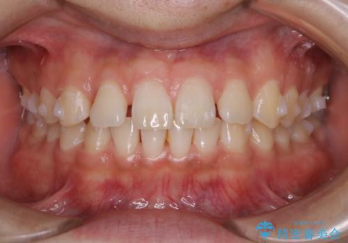 すきっ歯が気になる:見た目も噛み合わせもインビザラインでまとめて治すの治療中