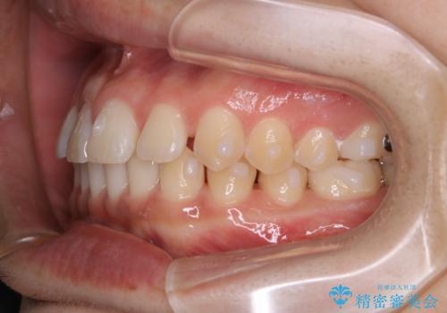 すきっ歯が気になる:見た目も噛み合わせもインビザラインでまとめて治すの治療中
