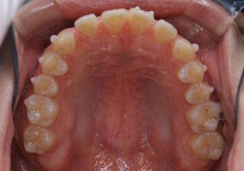 すきっ歯が気になる:見た目も噛み合わせもインビザラインでまとめて治すの治療中