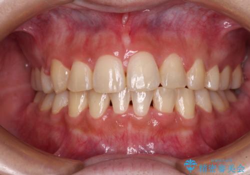 インビザラインが続けられない ワイヤー矯正での抜歯矯正 その1