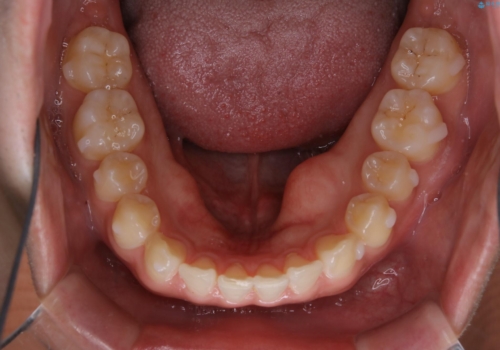 すきっ歯が気になる:見た目も噛み合わせもインビザラインでまとめて治すの治療中