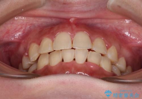 インビザラインが続けられない　ワイヤー矯正での抜歯矯正　その1の治療後