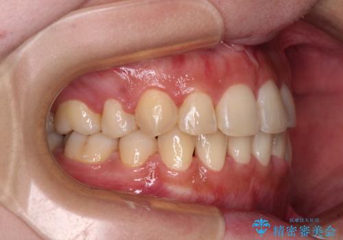 インビザラインが続けられない　ワイヤー矯正での抜歯矯正　その1の治療後