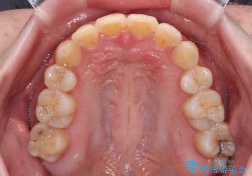 インビザラインが続けられない　ワイヤー矯正での抜歯矯正　その1の治療後