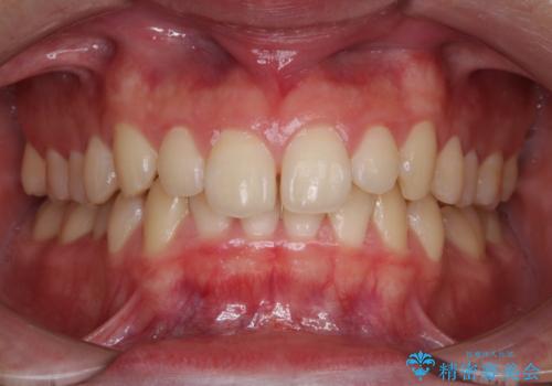 前歯が見えすぎる:インビザラインFULLで奥歯の噛み合わせも改善の症例 治療前