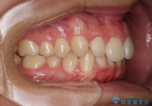 前歯が見えすぎる:インビザラインFULLで奥歯の噛み合わせも改善の治療前