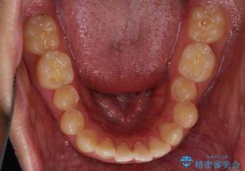 前歯が見えすぎる:インビザラインFULLで奥歯の噛み合わせも改善の治療前