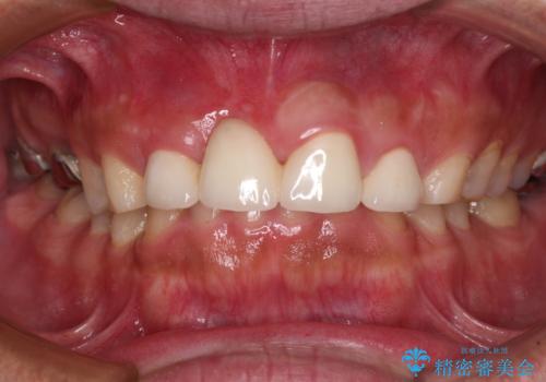 不自然な前歯 歯肉移植を用いた前歯のオールセラミックブリッジの治療後