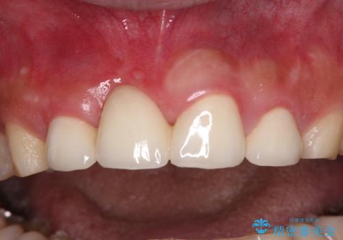 不自然な前歯　歯肉移植を用いた前歯のオールセラミックブリッジの治療後
