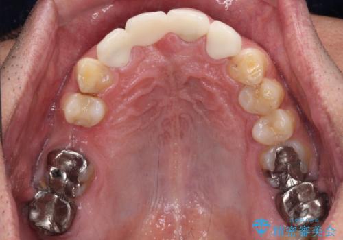 不自然な前歯 歯肉移植を用いた前歯のオールセラミックブリッジの治療後