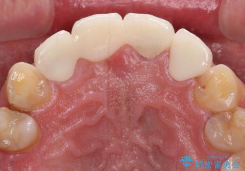 不自然な前歯 歯肉移植を用いた前歯のオールセラミックブリッジの治療後