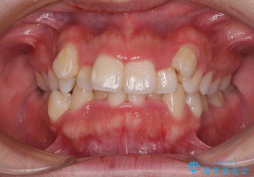 【モニター】八重歯を抜歯矯正でスッキリした口元にの症例 治療前