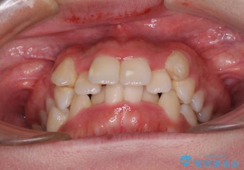 【モニター】八重歯を抜歯矯正でスッキリした口元にの治療前